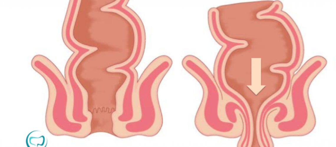 Principais perguntas relacionadas ao prolapso retal