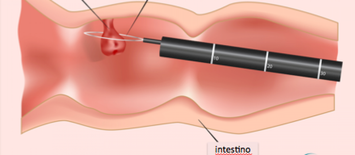 Uma das formas de se retirar um pólipo intestinal é através de uma laçada em usa base durante a colonoscopia