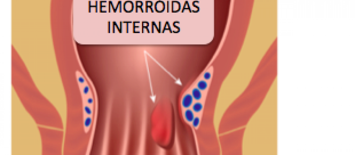 Hemorróidas podem ser divididas entre internas e externas e cada uma tem sintomas e tratamentos diferentes