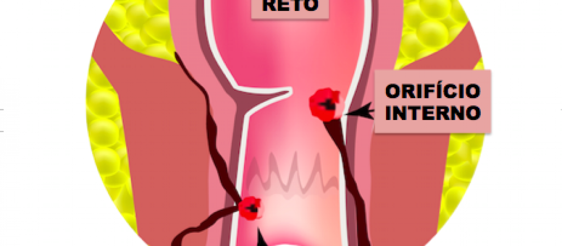 A fístula perianal é a comunicação de uma glândula do ânus com a superfície do glúteo que passa aravés de um túnel